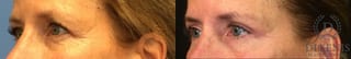 Before and after Eye Lid Surgery case 35059 - Angle 4