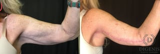 Before and after Arm Lift case 35061 - Angle 1