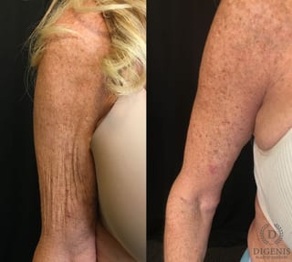 Before and after Arm Lift case 35061 - Angle 3
