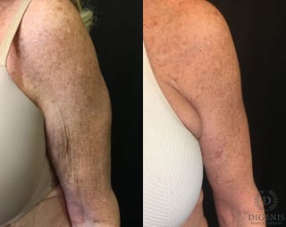 Before and after Arm Lift case 35061 - Angle 4