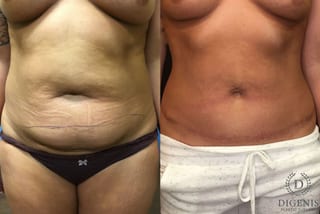 Before and after Tummy Tuck case 35066 - Angle 1