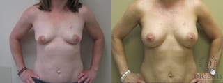 Before and after Breast Lift with or without Implants case 35069 - Angle 1