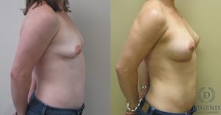 Before and after Breast Lift with or without Implants case 35069 - Angle 3