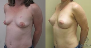 Before and after Breast Lift with or without Implants case 35069 - Angle 4