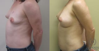 Before and after Breast Lift with or without Implants case 35069 - Angle 5