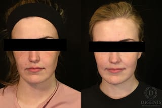Before and after Digenis Refresh Lift case 35075 - Angle 1