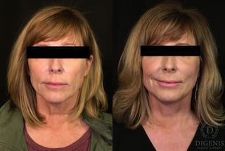 Before and after Digenis Refresh Lift case 35076 - Angle 1