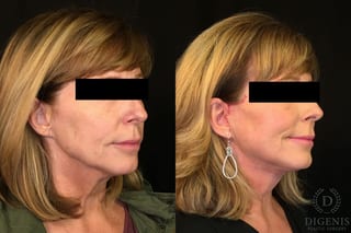 Before and after Digenis Refresh Lift case 35076 - Angle 2