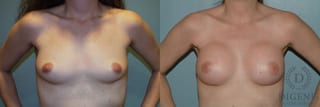 Before and after Breast Augmentation case 35080 - Angle 1