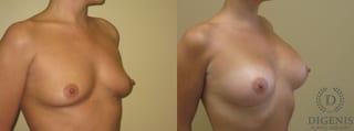 Before and after Breast Augmentation case 35081 - Angle 2