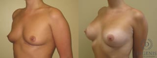 Before and after Breast Augmentation case 35081 - Angle 3