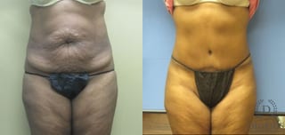 Before and after Tummy Tuck case 35082 - Angle 1