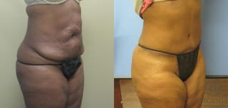Before and after Tummy Tuck case 35082 - Angle 2