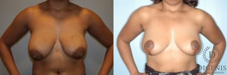 Before and after Breast Lift with or without Implants case 35083 - Angle 1