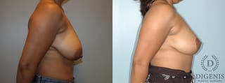 Before and after Breast Lift with or without Implants case 35083 - Angle 2