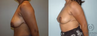 Before and after Breast Lift with or without Implants case 35083 - Angle 3
