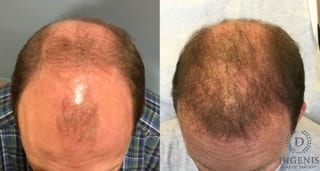 Before and after Hair Restoration/ Hair Thinning case 35085 - Angle 1