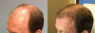 Before and after Hair Restoration/ Hair Thinning case 35085 - Angle 2