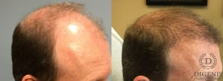 Before and after Hair Restoration/ Hair Thinning case 35085 - Angle 3