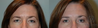 Before and after Eye Lid Surgery case 35086 - Angle 1