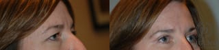 Before and after Eye Lid Surgery case 35086 - Angle 2