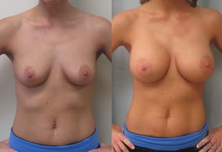 Before and after Breast Augmentation case 35087 - Angle 1