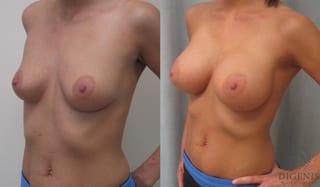Before and after Breast Augmentation case 35087 - Angle 2