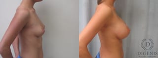 Before and after Breast Augmentation case 35087 - Angle 5