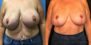 Before and after Breast Lift with or without Implants case 35088 - Angle 1