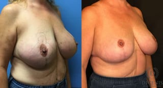 Before and after Breast Lift with or without Implants case 35088 - Angle 2