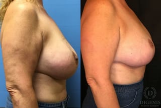 Before and after Breast Lift with or without Implants case 35088 - Angle 3