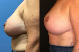 Before and after Breast Lift with or without Implants case 35088 - Angle 4
