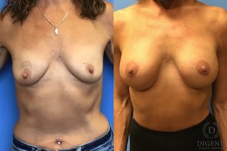 Before and after Breast Lift with or without Implants case 35089 - Angle 1