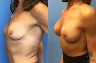 Before and after Breast Lift with or without Implants case 35089 - Angle 2