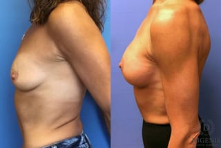 Before and after Breast Lift with or without Implants case 35089 - Angle 3