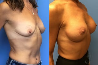 Before and after Breast Lift with or without Implants case 35089 - Angle 4