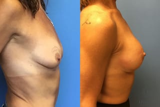 Before and after Breast Lift with or without Implants case 35089 - Angle 5