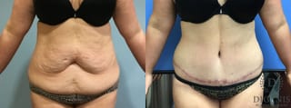 Before and after Tummy Tuck case 35090 - Angle 1