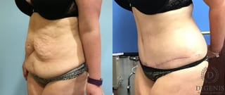 Before and after Tummy Tuck case 35090 - Angle 4