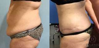 Before and after Tummy Tuck case 35090 - Angle 5