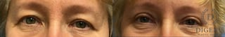 Before and after Eye Lid Surgery case 35092 - Angle 1