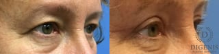 Before and after Eye Lid Surgery case 35092 - Angle 2
