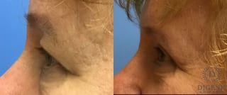 Before and after Eye Lid Surgery case 35092 - Angle 5