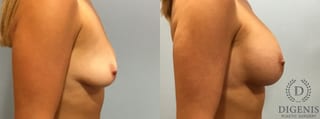 Before and after Breast Lift with or without Implants case 35093 - Angle 3