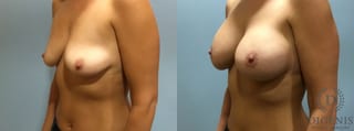Before and after Breast Lift with or without Implants case 35093 - Angle 4