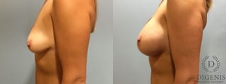 Before and after Breast Lift with or without Implants case 35093 - Angle 5