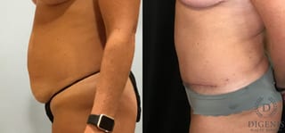 Before and after Tummy Tuck case 35094 - Angle 5