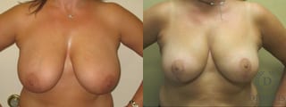 Before and after Breast Lift with or without Implants case 35095 - Angle 1