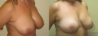 Before and after Breast Lift with or without Implants case 35095 - Angle 2