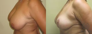 Before and after Breast Lift with or without Implants case 35095 - Angle 5